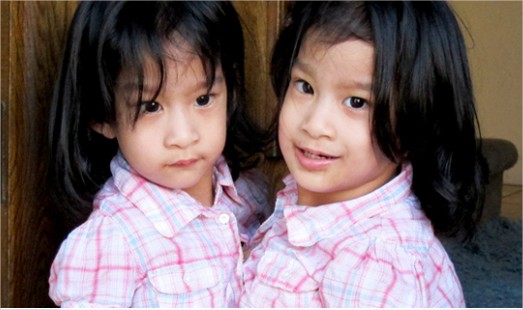 Éxito en la separación de las gemelas filipinas
