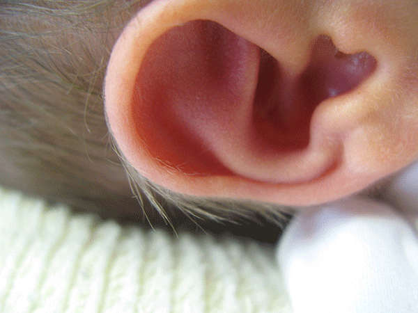 Detectar precozmente los problemas auditivos III