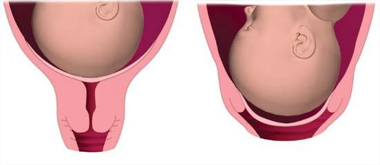 ¿Qué significa que el cuello del útero se ha borrado?