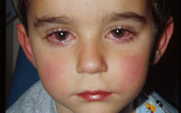 La alergia en los ojos del bebé