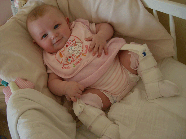 Explorar las caderas del bebé: displasia de cadera II
