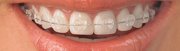 Nueva ortodoncia: brackets de porcelana
