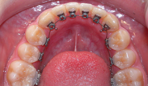 Nueva ortodoncia: brackets linguales