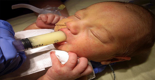 Alimentar al prematuro recién nacido II