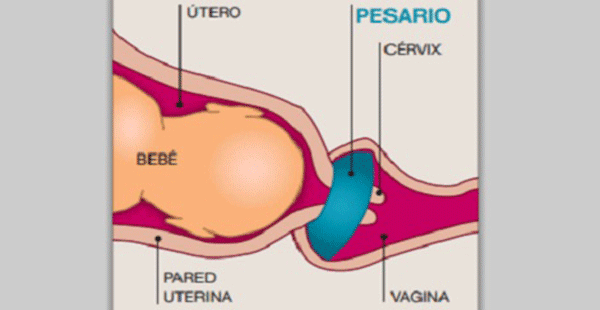 Pesario cervical II
