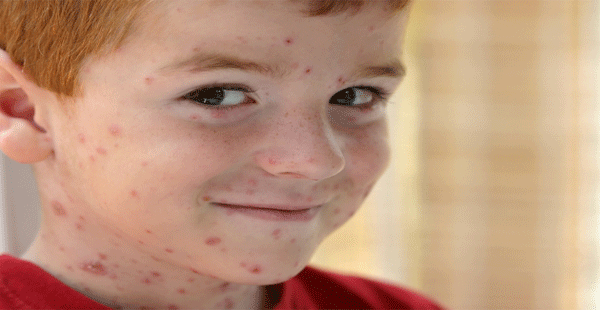 Lo que hay que saber de la varicela