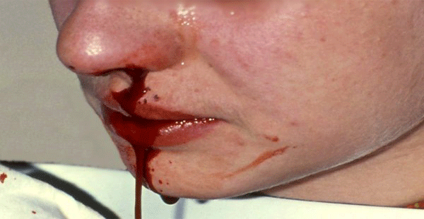 ¿Por qué le sangra tanto la nariz? II